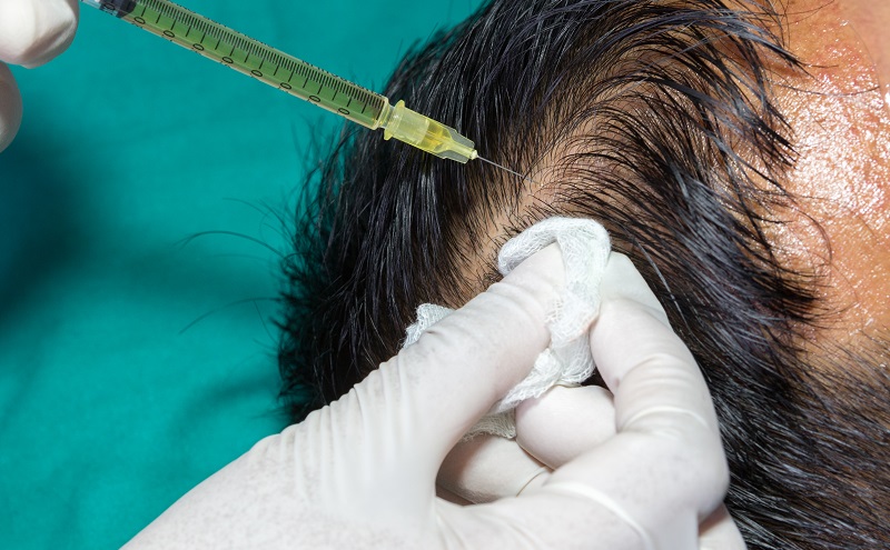 Im ersten Behandlungsschritt entnimmt der Haarchirurg die Spenderhaare mithilfe einer Hohlnadel, deren Durchmesser kleiner als 1 mm ist. (#02)