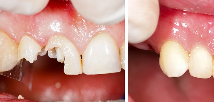 Zahnbruch: Das hilft bei einer Zahnfraktur