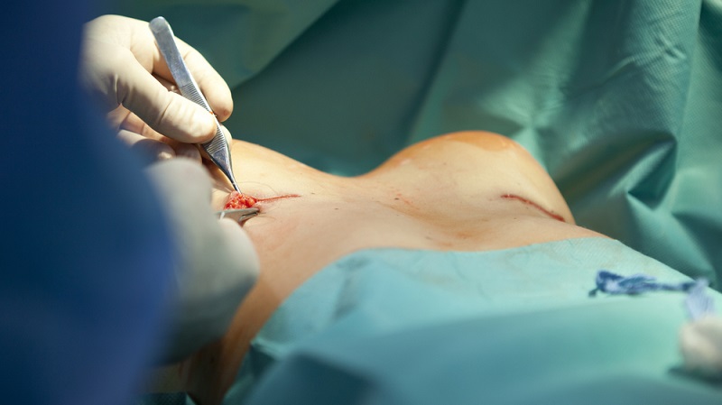 Der Arzt haftet nur dann für eine misslungene Brust OP, wenn ein nachgewiesener Behandlungsfehler vorliegt.  (Foto: Shutterstock-resket)