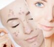 Unreine Haut: Die richtige Hautpflege bei Pickeln ( Foto: Shutterstock - transurfer )