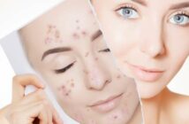 Unreine Haut: Die richtige Hautpflege bei Pickeln ( Foto: Shutterstock - transurfer )